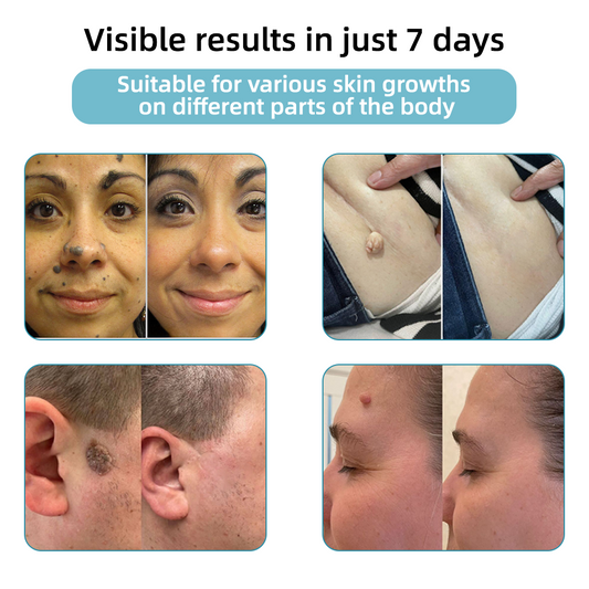 Aprolo™ Non-invasive Mole and Wart Removal Laser Pen