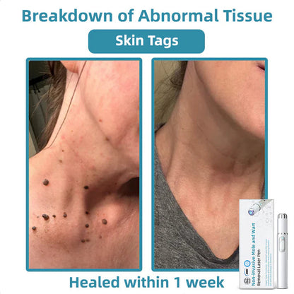 Aprolo™ Non-invasive Mole and Wart Removal Laser Pen