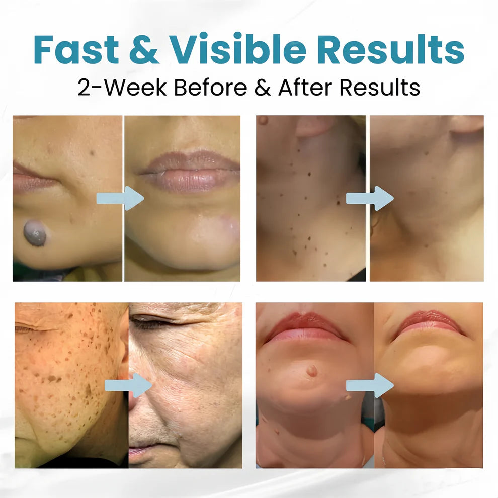 Aprolo™ Non-invasive Mole and Wart Removal Laser Pen
